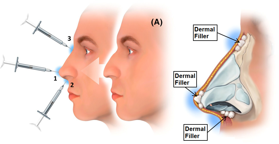 Dermal Filler palcement in nose