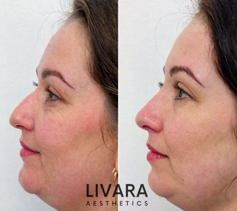 Non Surgical Rhinoplasty Pros Cons Of Nose Filler Treatments Liquid Nose Job In Birmingham 768x684 