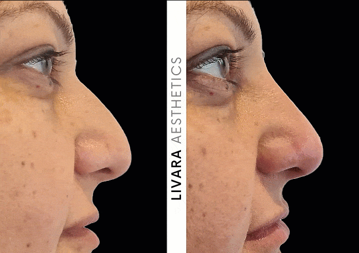 Nose Filler West Midlands