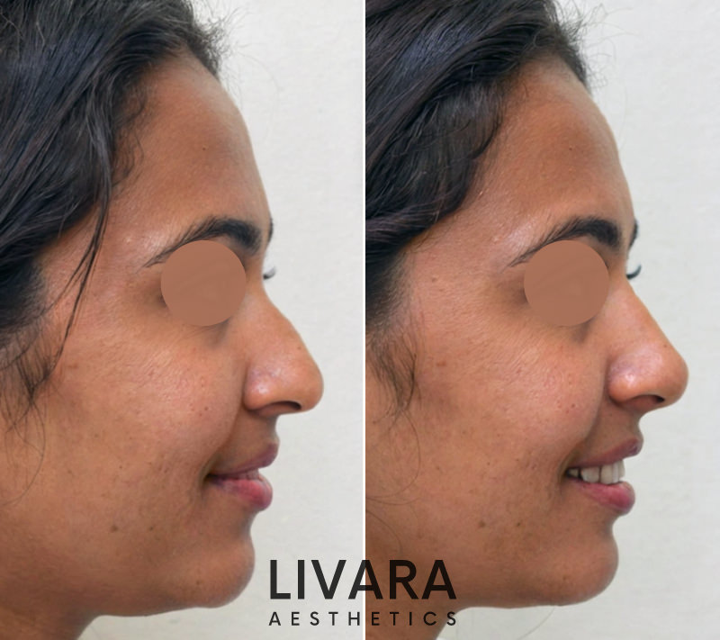 Non surgical nose job before and after