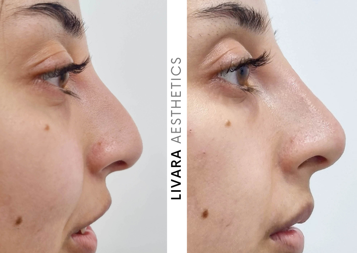 Downturned Non Surgical Nose