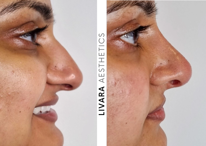 Liquid Nose Job in Birmingham