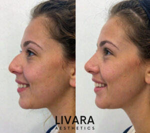 Birmingham liquid nose job treatment