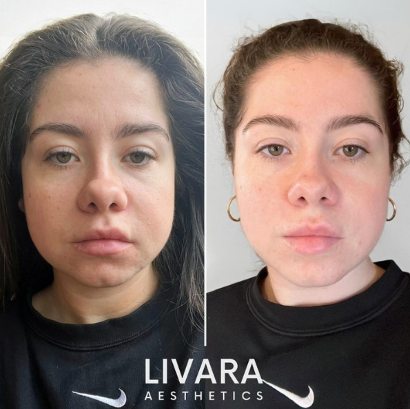 Masseter Botox for Jawline slimming