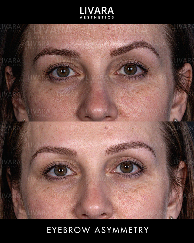 Botox for uneven eyebrows in Birmingham