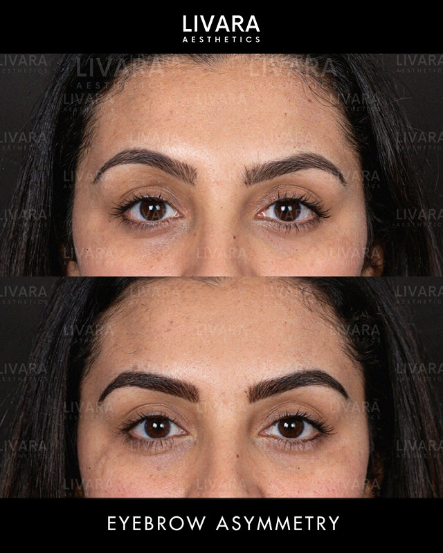 botox to fix eyebrow asymmetry - Birmingham