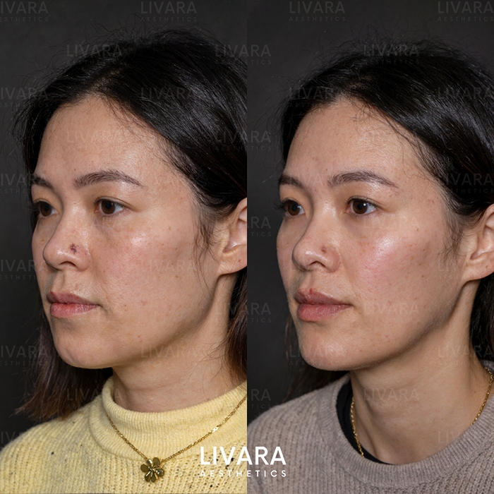 Profile Balancing_Birmingham_Livara Aesthetics_21