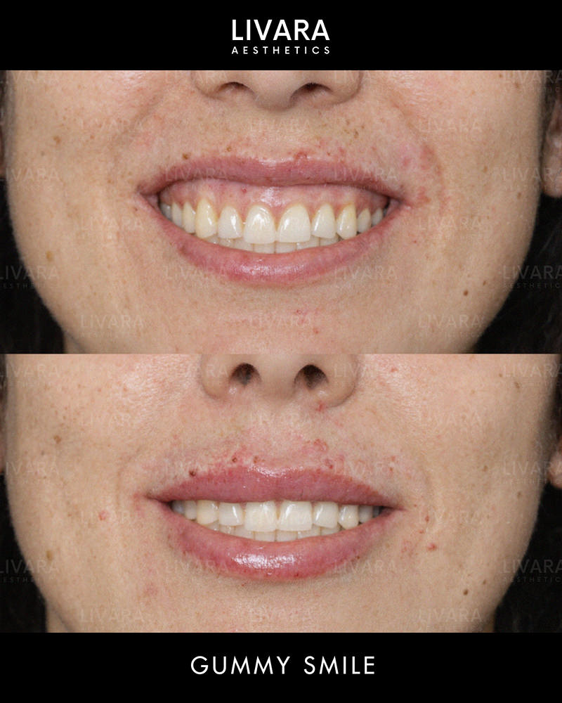 Gummy Smile Botox in Birmingham_Livara Aesthetics