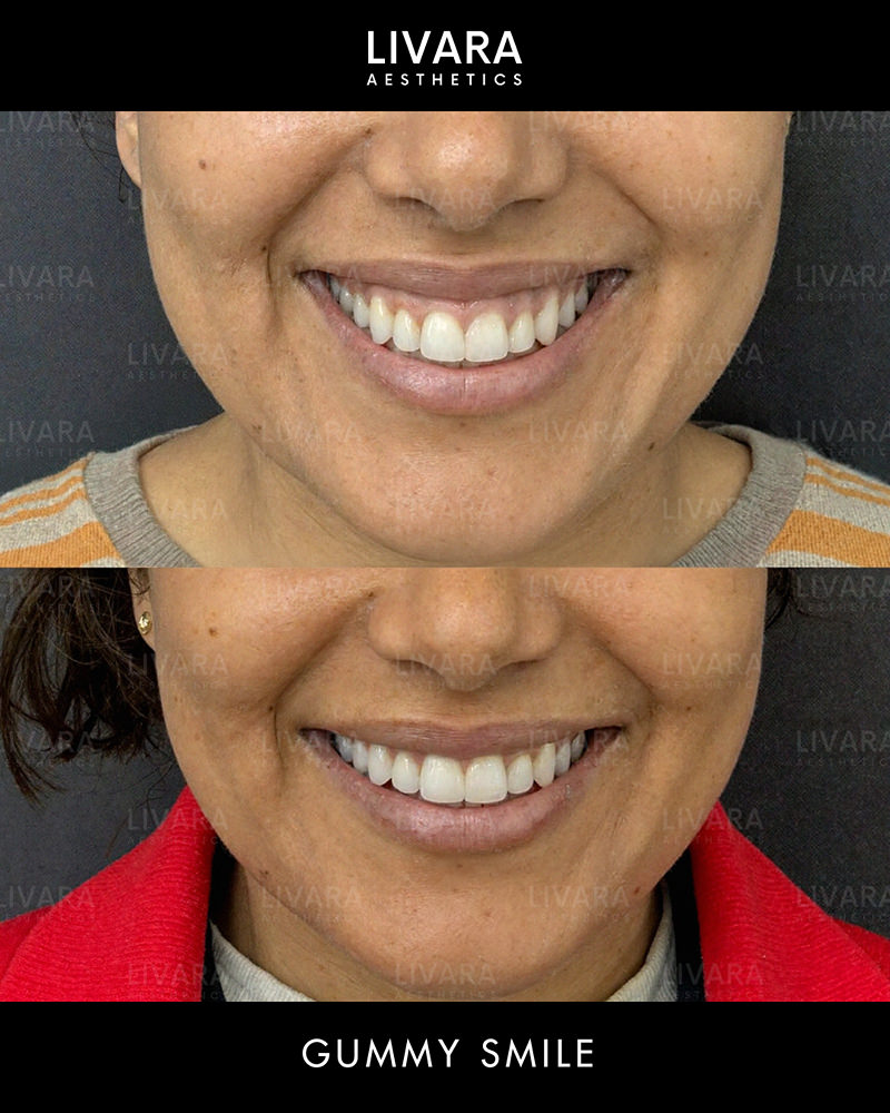 Gummy Smile Correction_Birmingham